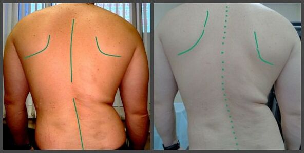 Osteokondroz ilə onurğanın əyriliyi