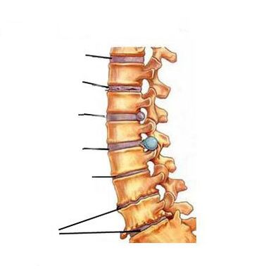 Osteokondroz necə inkişaf edir