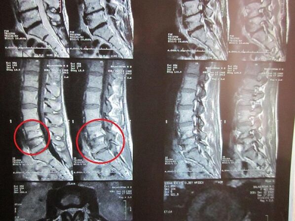 Servikal osteokondrozun diaqnozu