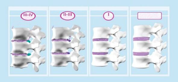 Servikal osteokondrozun mərhələləri