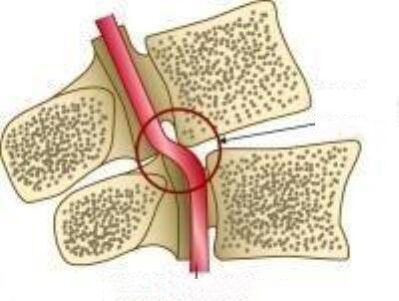 Vail artery sindromu