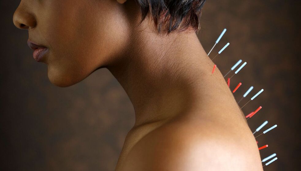 servikal osteokondroz ilə akupunktur