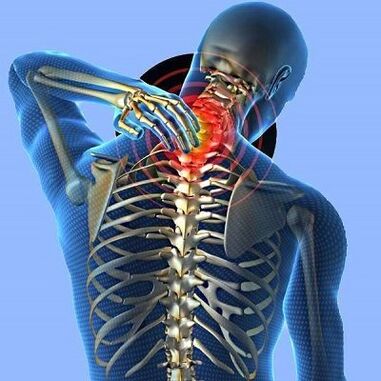 servikal osteokondroz ilə boyun ağrısı