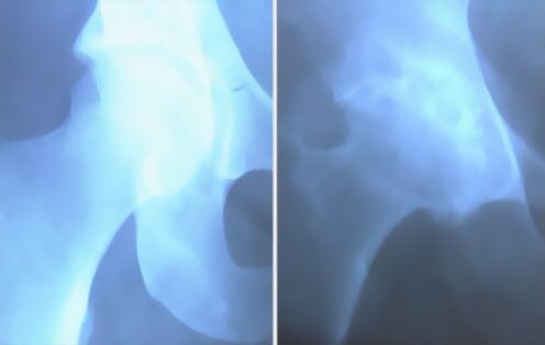 Diz ekleminin artrozu