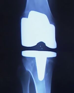 X -Ree'nin birləşməsini dəyişdirmək üçün əməliyyatdan sonra bir süni protez ilə dizin şəkli