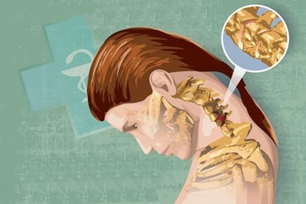 Osteokondrozun refleks simptomları